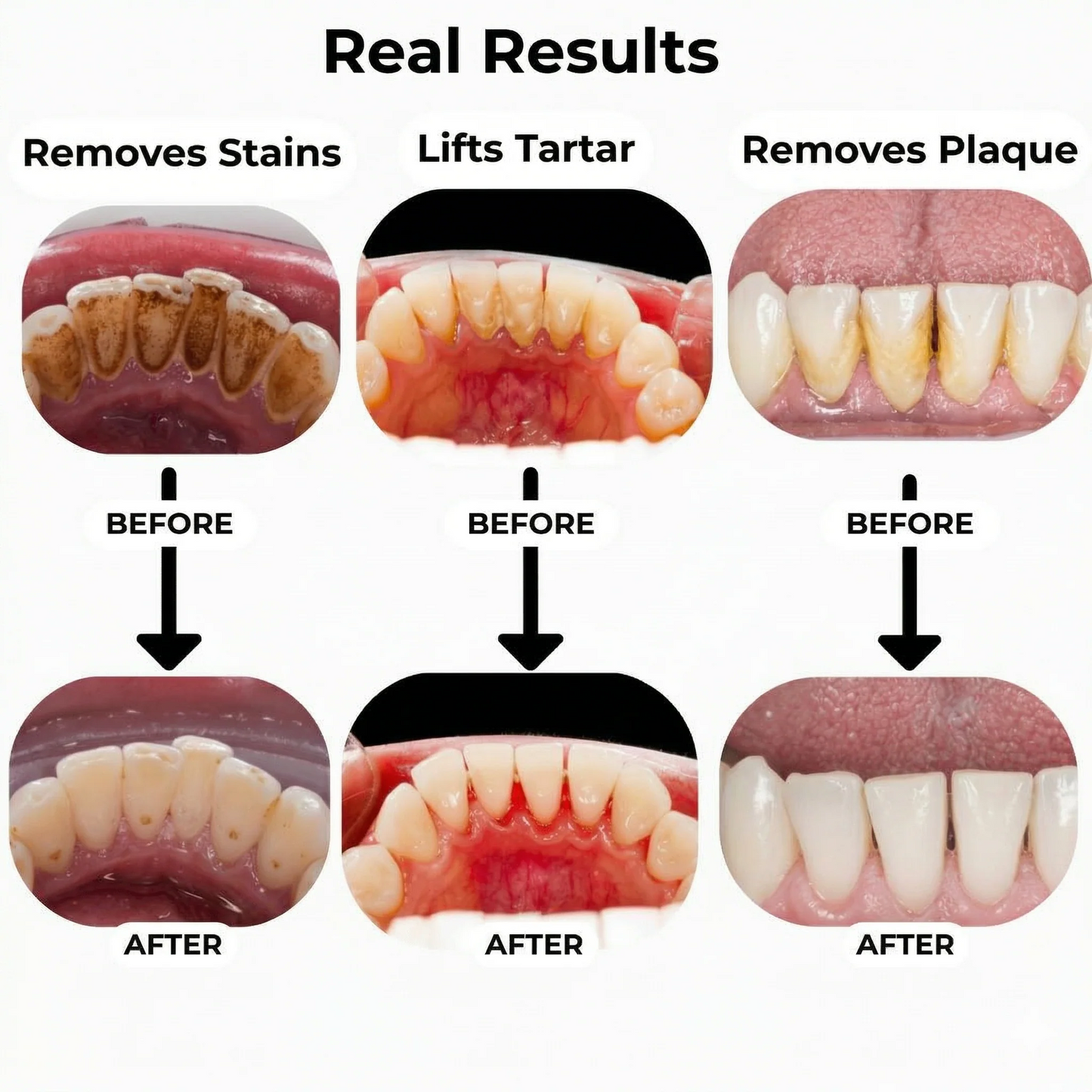 Smart Ultra-Sonic Teeth Cleaner